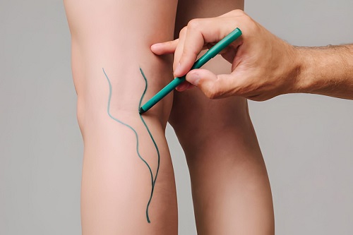 Best Vascular Surgeon in Vile Parle, Mumbai